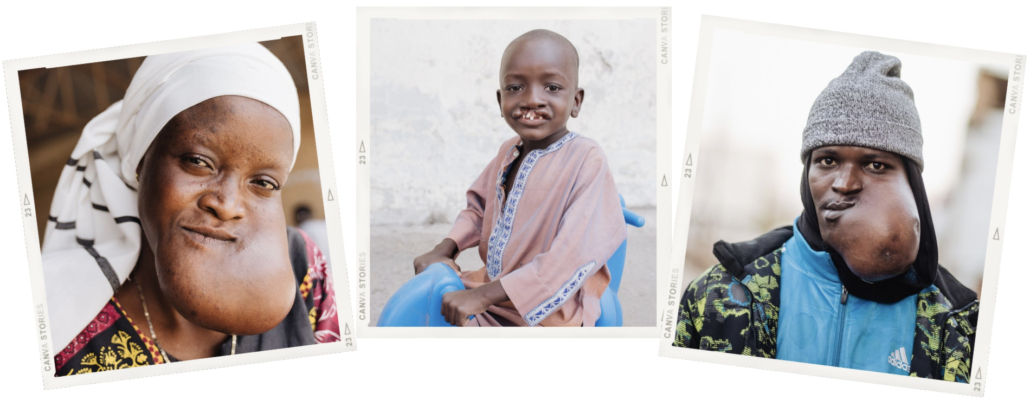 Patiënten Mercy Ships in Senegal