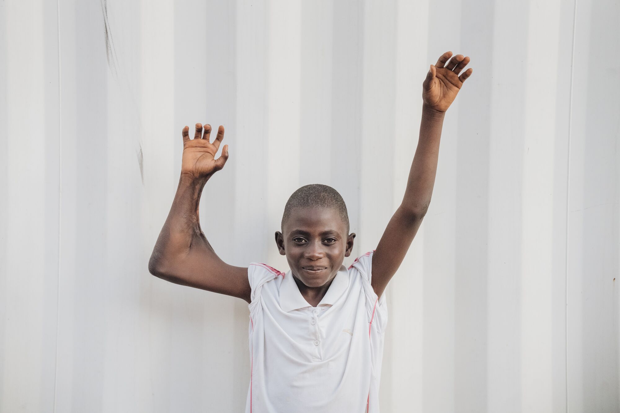 SLG241126_DAVID_SLG09258_BEFORE_IW003_HI-MID David en de verbrande huid op zijn arm